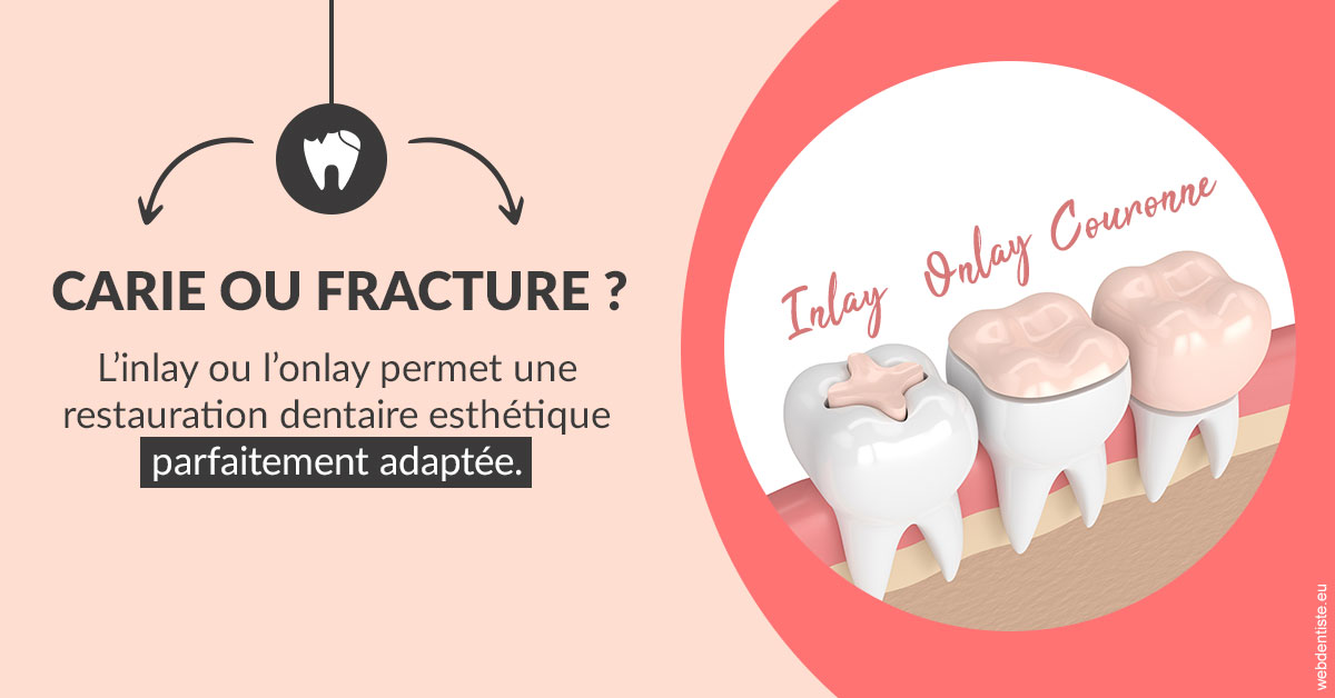 https://dr-thomas-valerie.chirurgiens-dentistes.fr/T2 2023 - Carie ou fracture 2