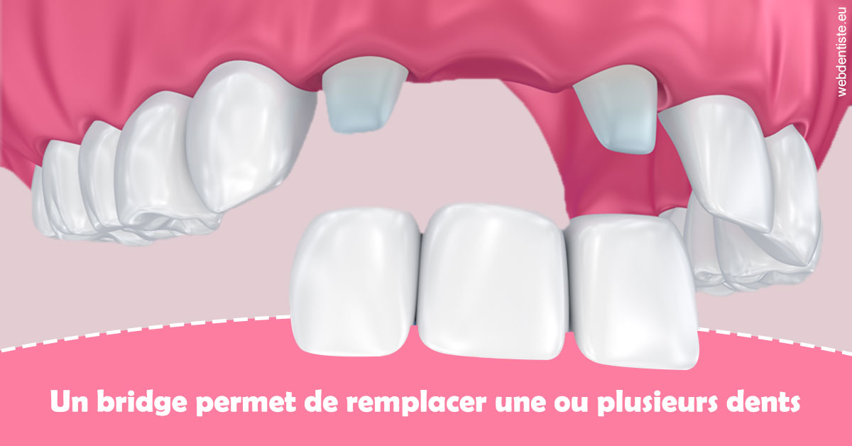 https://dr-thomas-valerie.chirurgiens-dentistes.fr/Bridge remplacer dents 2