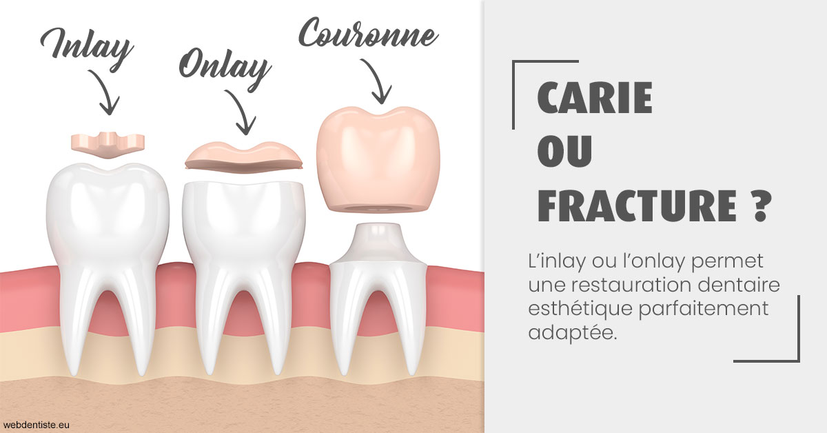 https://dr-thomas-valerie.chirurgiens-dentistes.fr/T2 2023 - Carie ou fracture 1