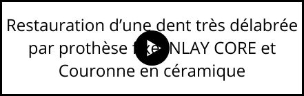 Restauration par prothèse fixe INLAY CORE et couronne en céramique